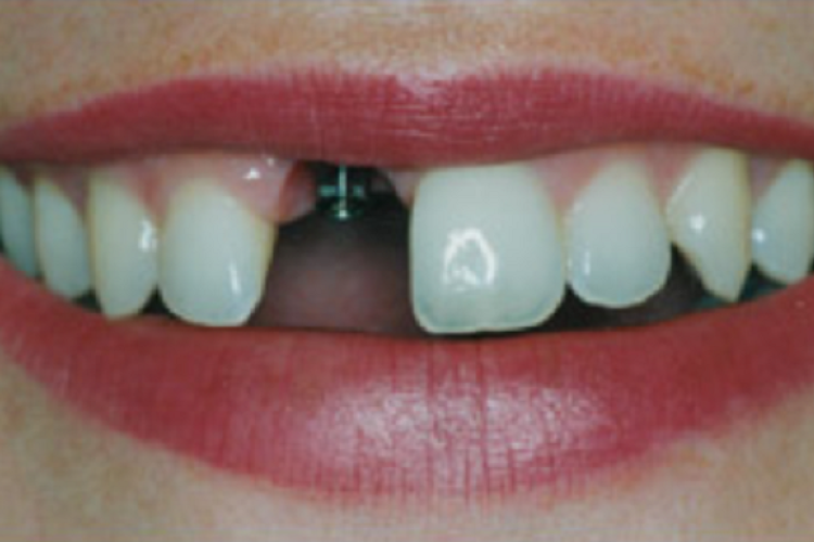 Sokan nem tudják, hogy a fogmegtartó kezelések mai napig ingyenesek