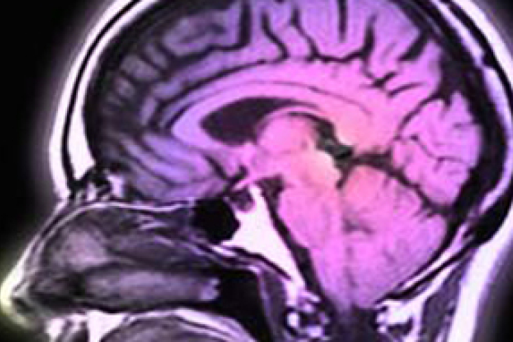 Hogyan védekezik az agy a stroke okozta károsodás ellen?